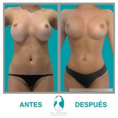 Lipo VASER y corrección de implantes de mama- Dr. Nephtali Alfonso Ortiz Lucio