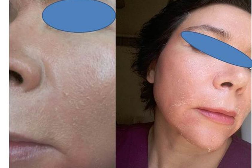 Peeling antes y después - 600707