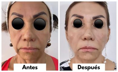Antes y después de Hilos tensores - Noorus Dra. Maria Eugenia Treviño