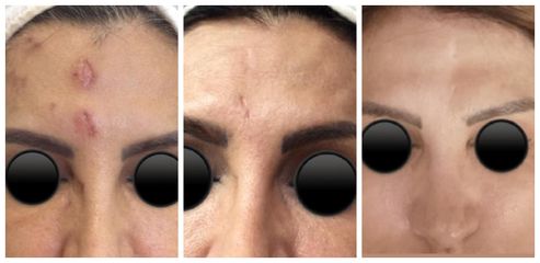 Antes y después de Eliminación de cicatrices - Noorus Dra. Maria Eugenia Treviño