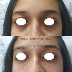 Eliminación de ojeras - Dra. Norma Zúñiga