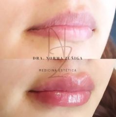 Aumento de labios - Dra. Norma Zúñiga