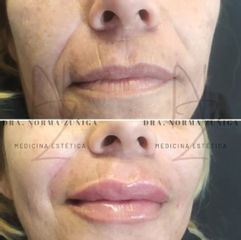 Aumento de labios - Dra. Norma Zúñiga