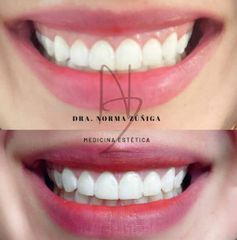 Corrección de sonrisa gingival - Dra. Norma Zúñiga