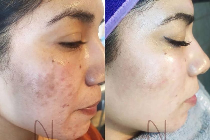 Plasma Rico en Plaquetas antes y después - 819622
