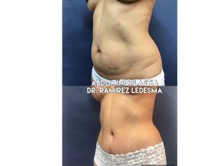 Antes y después de Abdominoplastia