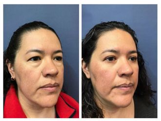 Blefaroplastia - 637039