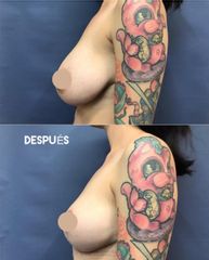 Antes y después de Reducción de mamas