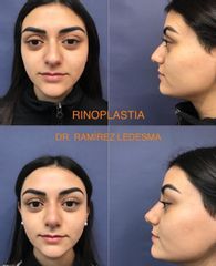 Antes y después de Rinoplastia 