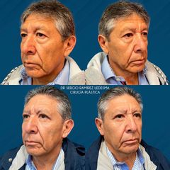 Antes y después de Blefaroplastia 
