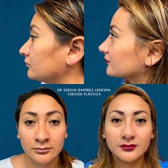 Antes y después de Rinoplastia 