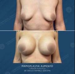 Aumento de busto - Dr. Sergio Guillermo Ramírez Ledesma