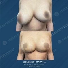 Reducción de mamas - Dr. Sergio Guillermo Ramírez Ledesma