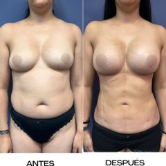 Liposucción + aumento de mama - Dr. Sergio Guillermo Ramírez Ledesma