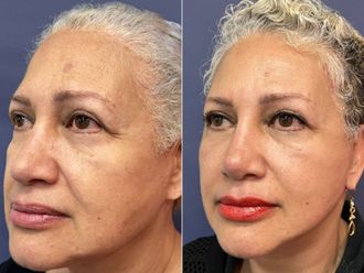 Rejuvenecimiento facial antes y después - 868318