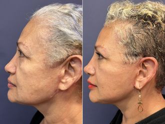 Rejuvenecimiento facial antes y después - 868319