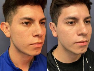 Otoplastia antes y después - 868370