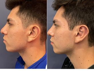 Otoplastia antes y después - 868373