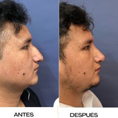 Rinoseptumplastia - Dr. Sergio Guillermo Ramírez Ledesma