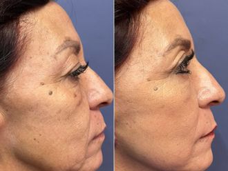 Rejuvenecimiento facial antes y después - 868520