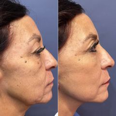 Rejuvenecimiento facial - Dr. Sergio Guillermo Ramírez Ledesma