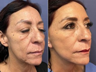 Rejuvenecimiento facial antes y después - 868521