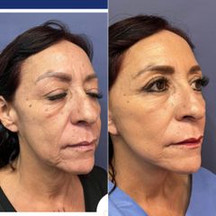 Rejuvenecimiento facial - Dr. Sergio Guillermo Ramírez Ledesma