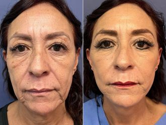 Rejuvenecimiento facial antes y después - 868522