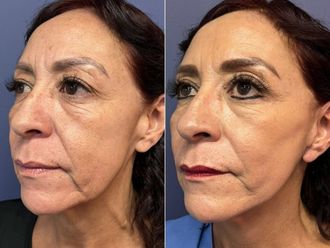 Rejuvenecimiento facial antes y después - 868523