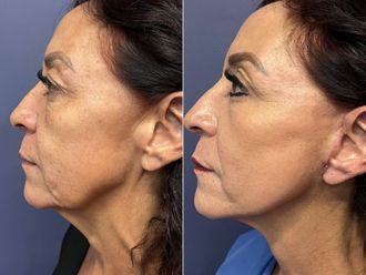 Rejuvenecimiento facial antes y después - 868524