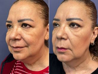 Blefaroplastia antes y después - 868546