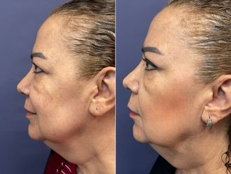 Blefaroplastia antes y después - 868547