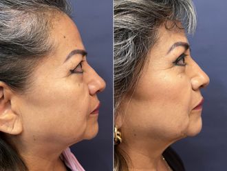 Blefaroplastia antes y después - 868573