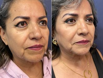 Blefaroplastia antes y después - 868574