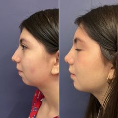 Rinoplastía + mentoplastía - Dr. Sergio Guillermo Ramírez Ledesma