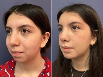Mentoplastia antes y después - 875839