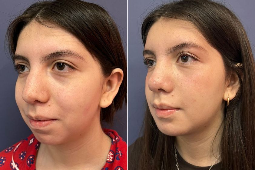 Mentoplastia antes y después - 875839