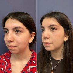 Rinoplastía + mentoplastía - Dr. Sergio Guillermo Ramírez Ledesma