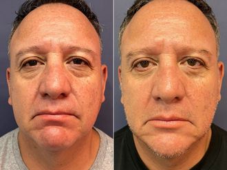 Blefaroplastia antes y después - 875851