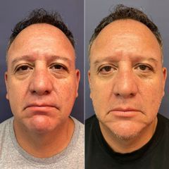 Blefaroplastia inferior - Dr. Sergio Guillermo Ramírez Ledesma