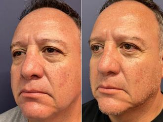 Blefaroplastia antes y después - 875852
