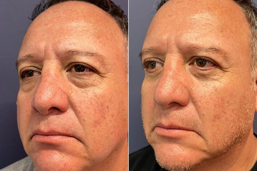 Blefaroplastia antes y después - 875852