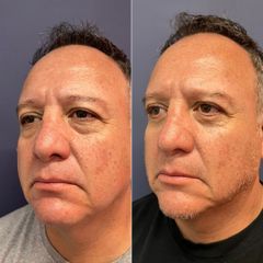 Blefaroplastia inferior - Dr. Sergio Guillermo Ramírez Ledesma
