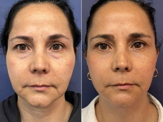 Rejuvenecimiento facial antes y después - 875853