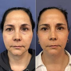 Rejuvenecimiento facial - Dr. Sergio Guillermo Ramírez Ledesma