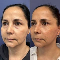 Rejuvenecimiento facial - Dr. Sergio Guillermo Ramírez Ledesma