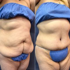 Abdominoplastía - Dr. Sergio Guillermo Ramírez Ledesma