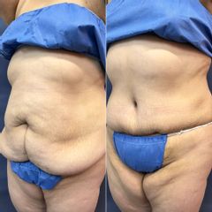 Abdominoplastía - Dr. Sergio Guillermo Ramírez Ledesma