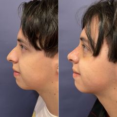 Rinoplastia - Dr. Sergio Guillermo Ramírez Ledesma