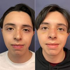 Rinoplastia - Dr. Sergio Guillermo Ramírez Ledesma